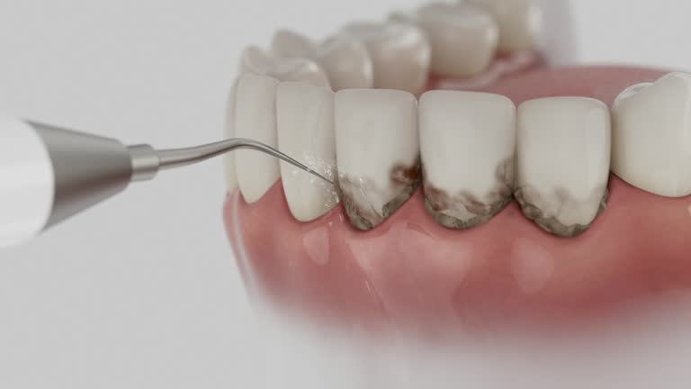 Reliable Wisdom Tooth Removal contractor in Benton, KY by Smile Center Dentistry